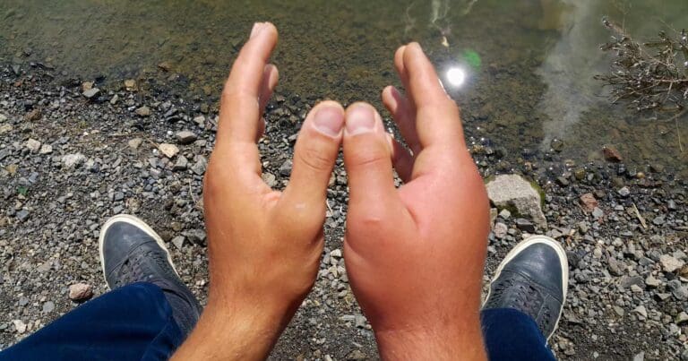 swollen hands when hiking