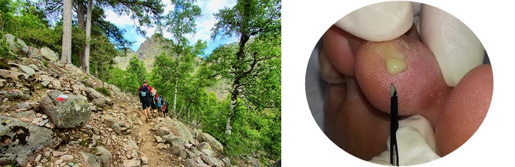 Foot care & blister treatment when hiking Foot care & blister treatment